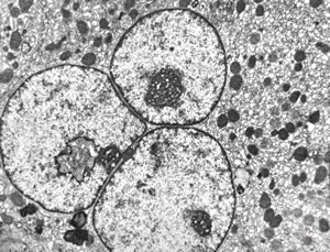 F,61y. | giant cell hepatitis F,61y. | giant cell hepatitis